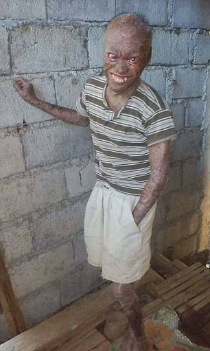 111ichthyosis