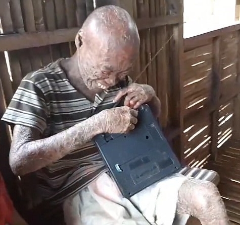 111ichthyosis.jpg3