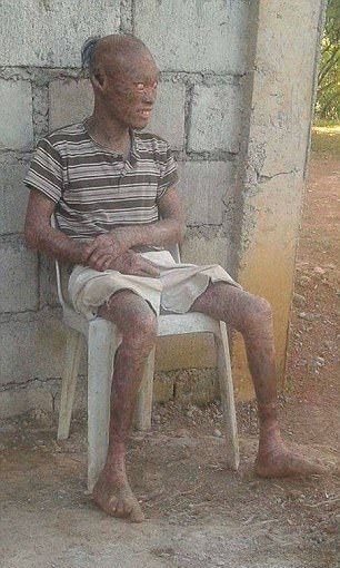 111ichthyosis.jpg4