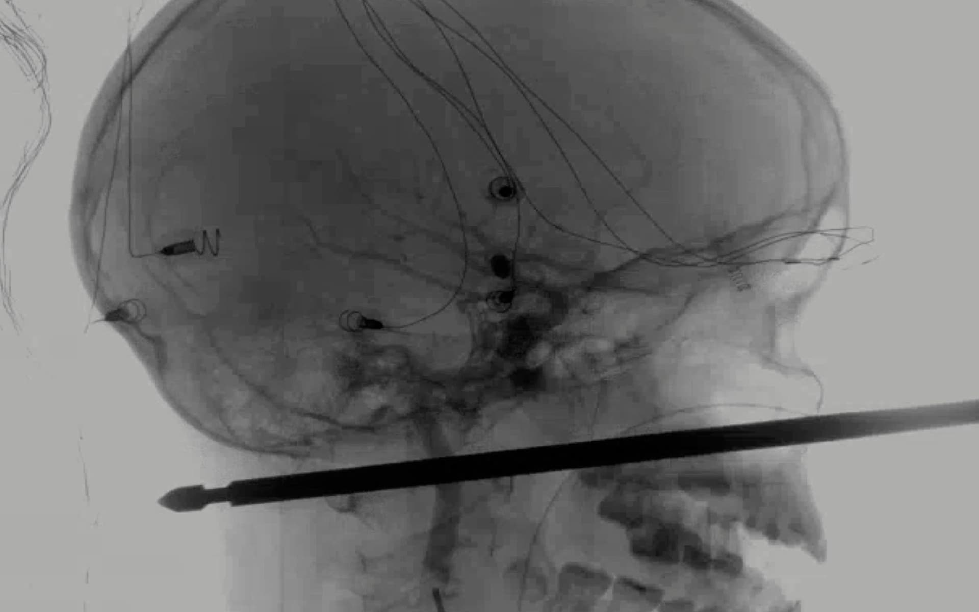 x-ray