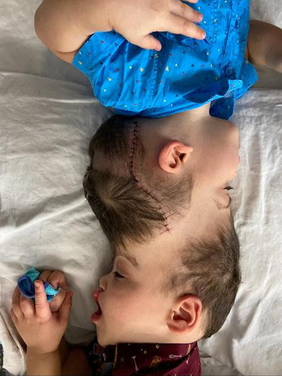 Conjoined twins, Bernardo and Arthur Lima, lie in bed, in Rio de Janeiro, Brazil July 2022. Gemini Untwined & Instituto Estadual do Cerebro Paulo Niemeyer/Handout via REUTERS THIS IMAGE HAS BEEN SUPPLIED BY A THIRD PARTY. NO RESALES. NO ARCHIVES. MANDATORY CREDIT