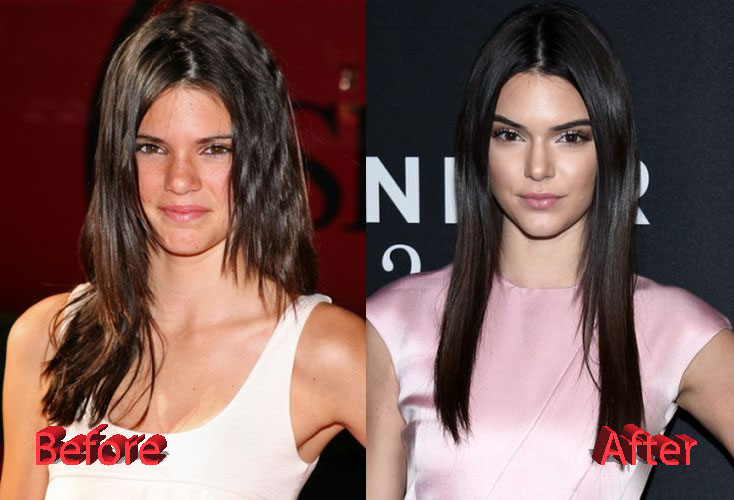 Kendall-Jenner-Plastic-Surgery-Before-and-After