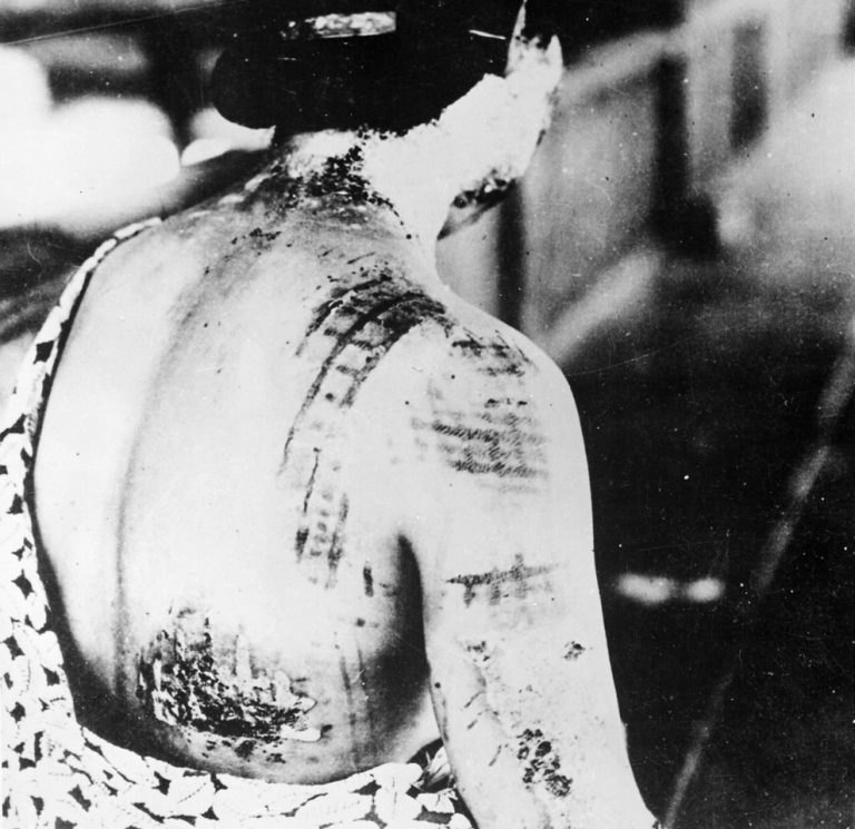 Radiation_burns_on_a_Japanese_woman_after_a_nuclear_explosion_in_1945-768x745