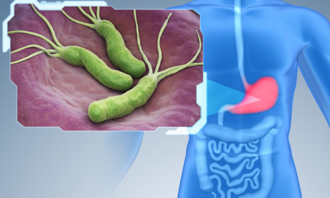 Helicobacter Pylori is a Gram-negative, microaerophilic bacterium found in the stomach. 3D illustration