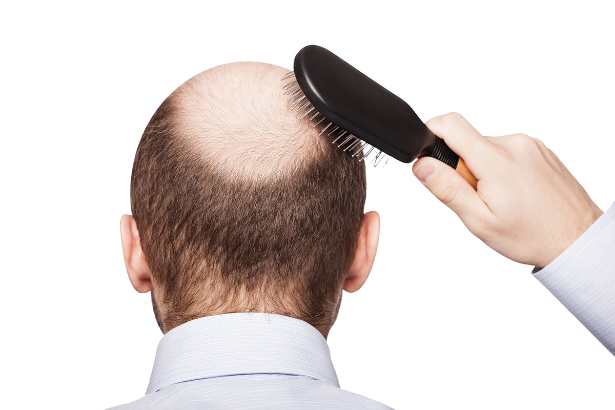 16764238 - human alopecia or hair loss - adult man hand holding comb on bald head