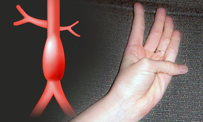 thumb-palm-aortic-aneurysm-666x399