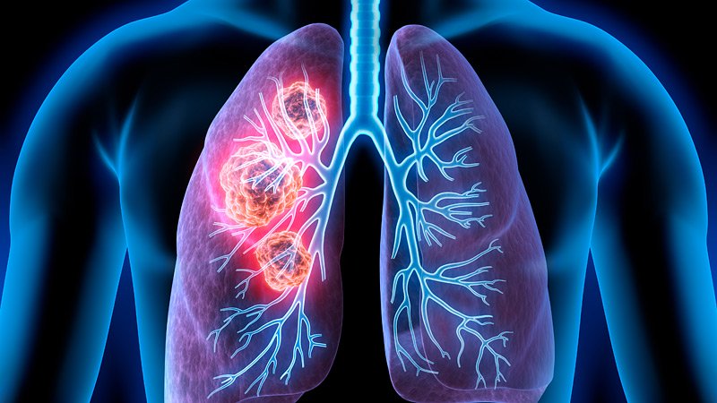 καρκίνος-πνεύμονα