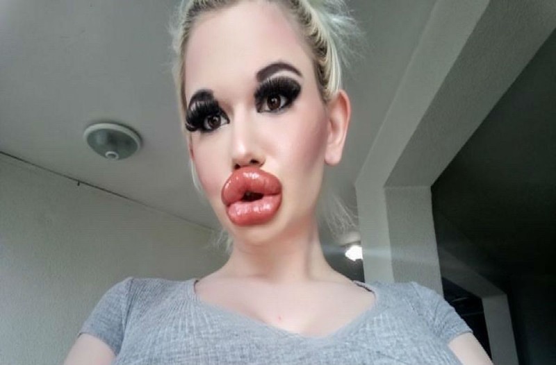 0_pay_woman_with_possibly_the_biggest_lips_in_the_world_shares_pics_of_her_ever_growing_pout_after_undoing